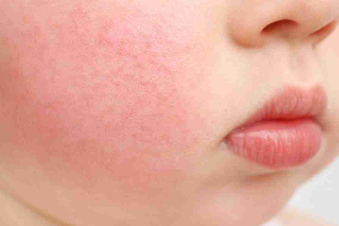 Красные щеки у детей - первый признак диатеза