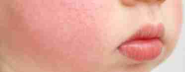 Красные щеки у детей - первый признак диатеза