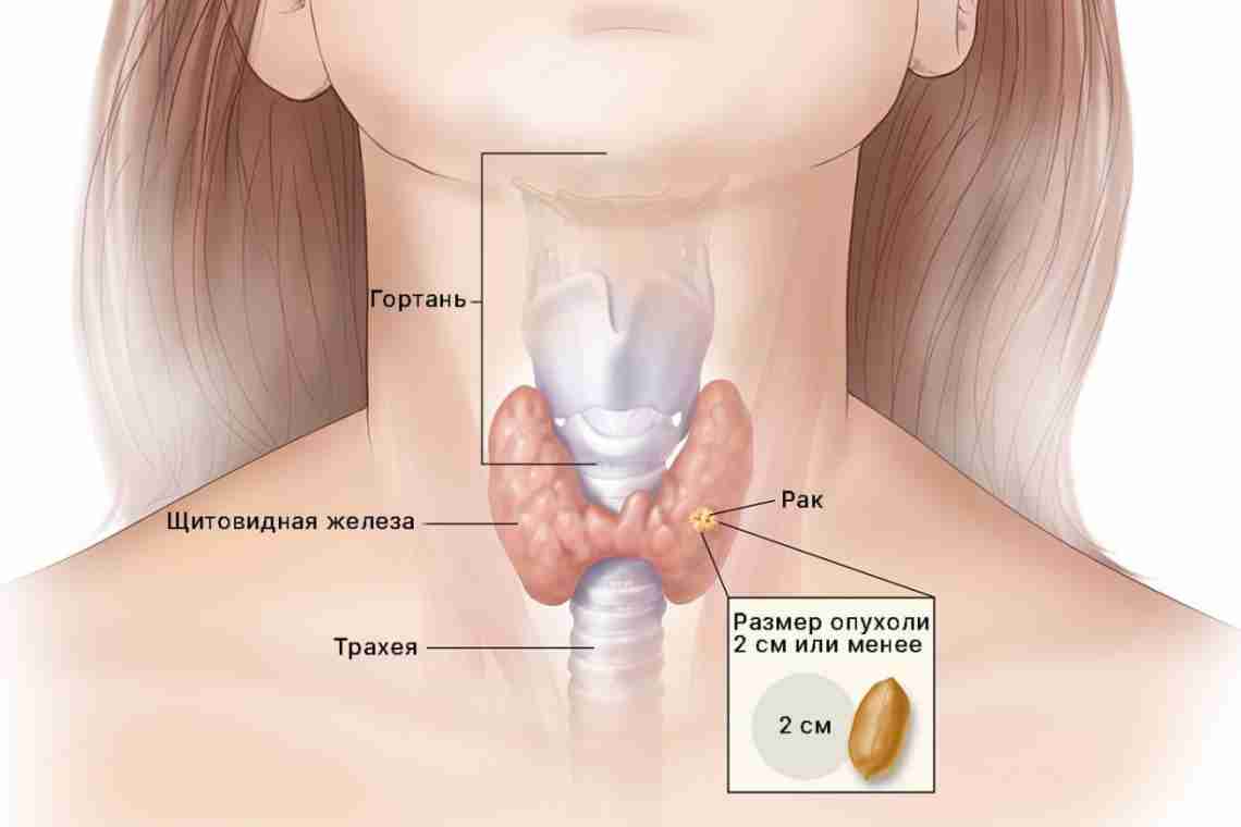 Воспаление щитовидной железы: симптомы и лечение