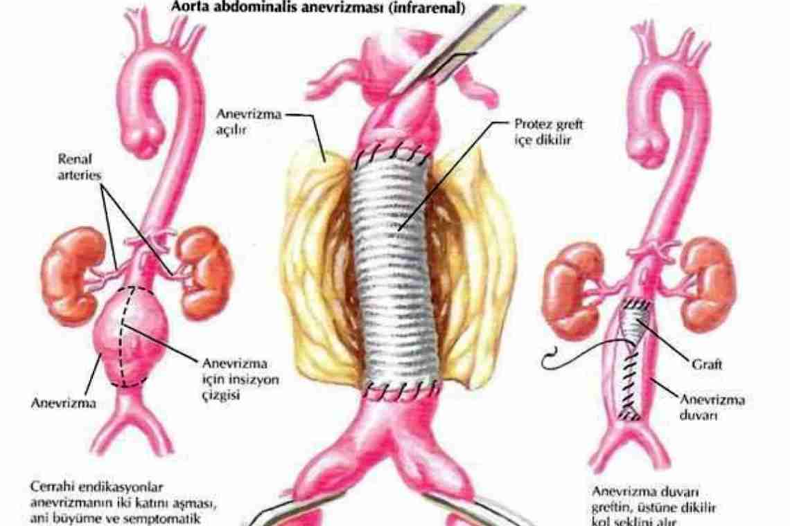 Аневризма аорты брюшной полости: причины, симптоматика и лечение