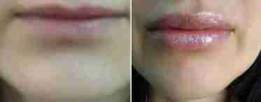 Отек после увеличения губ: сколько держится, описание симптомов, лечение и рекомендации врачей