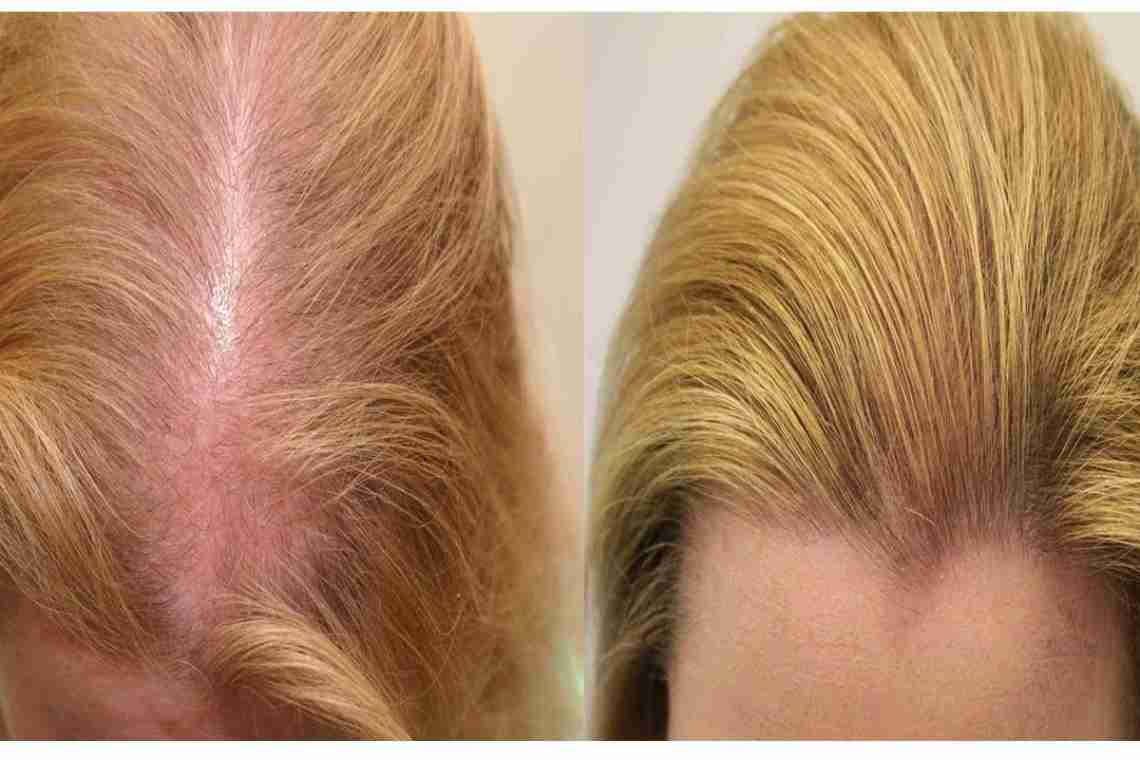 Что делать, если выпадает много волос? Полезные рекомендации