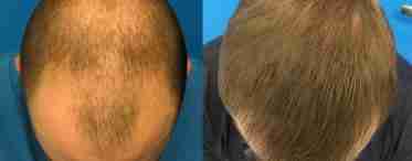 Восстановление волос у мужчин: методы и средства. Причины облысения у мужчин