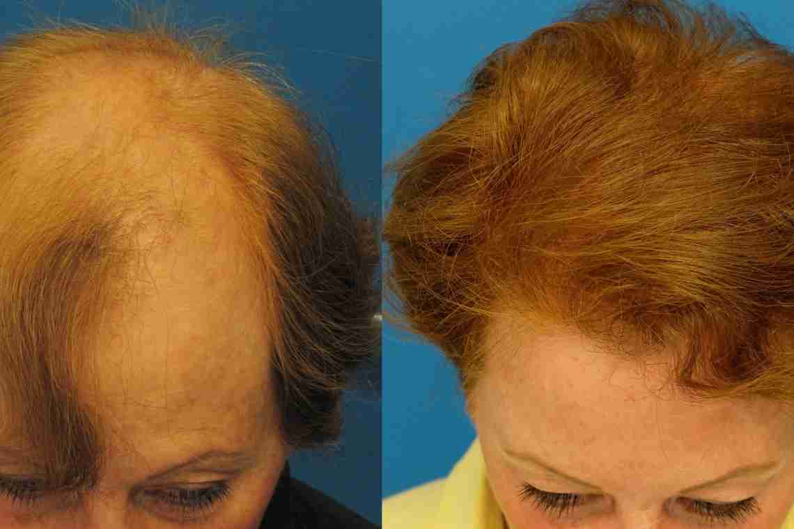 Причины, спровоцировавшие диффузное выпадение волос, и способы их устранения