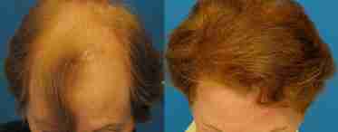 Причины, спровоцировавшие диффузное выпадение волос, и способы их устранения