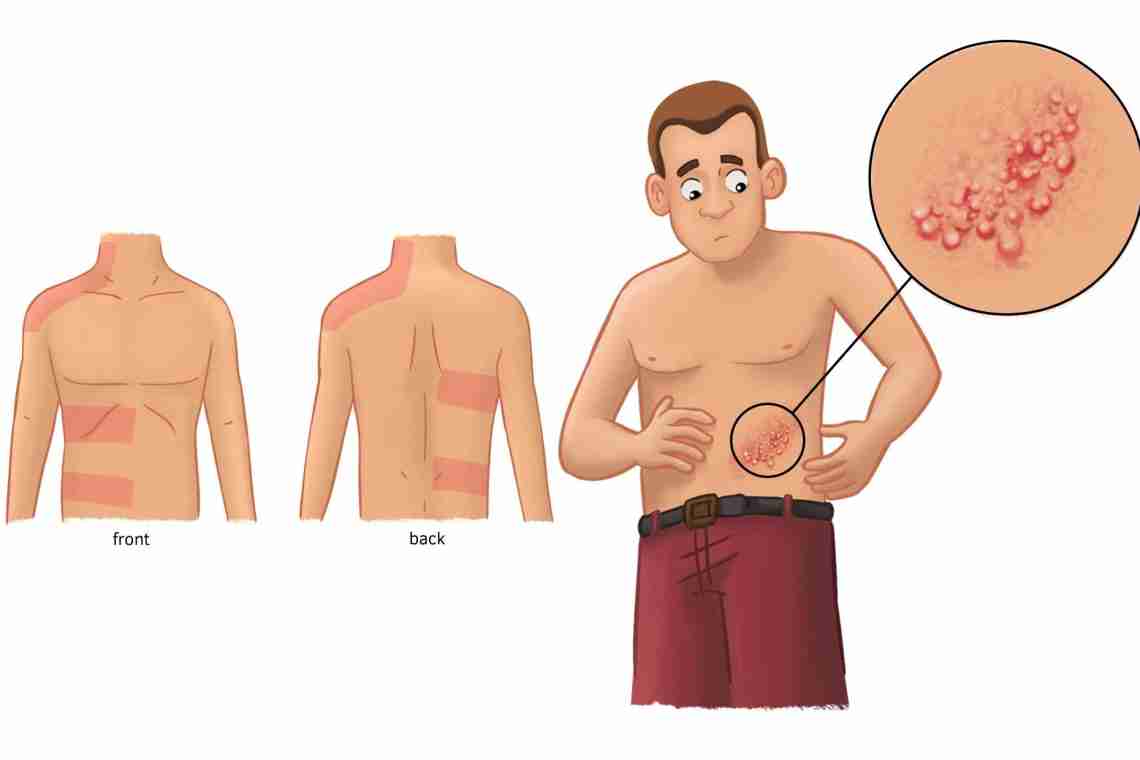 Сыпь на пололовых органах у мужчин: причины и последствия. Венерические заболевания, проявляющиеся в виде сыпи