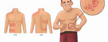 Сыпь на пололовых органах у мужчин: причины и последствия. Венерические заболевания, проявляющиеся в виде сыпи