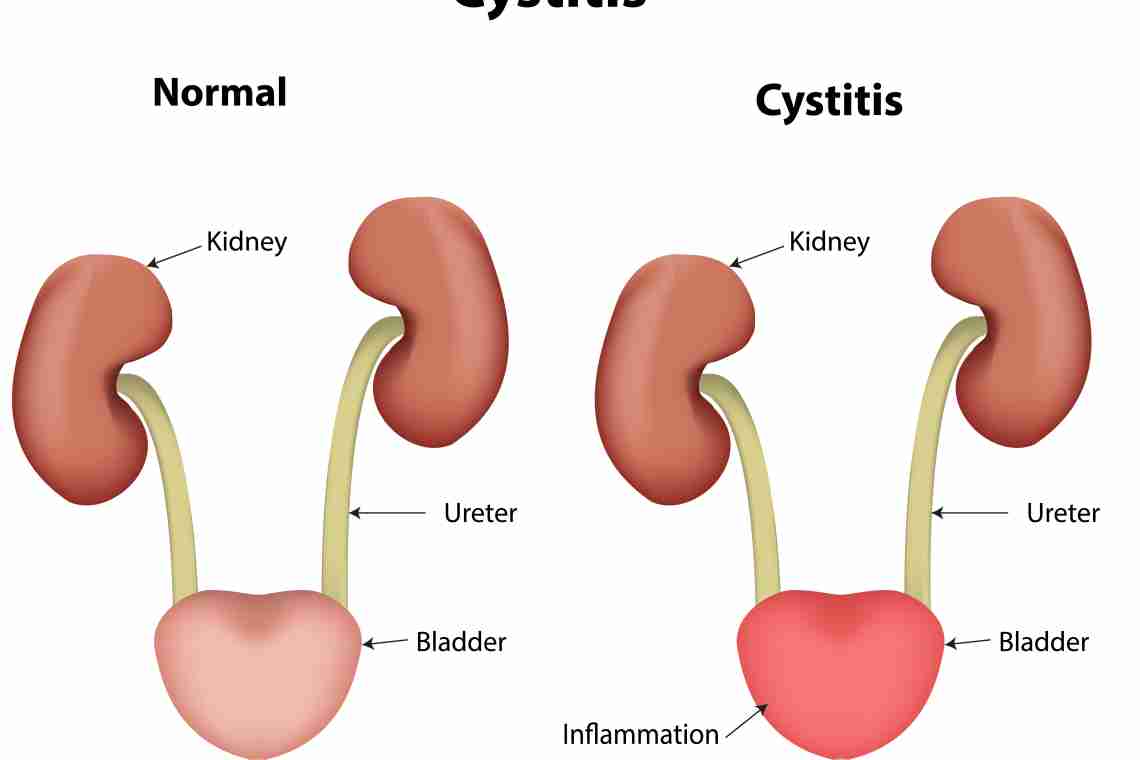 Воспаление мочевого пузыря лечение у мужчин - возможные причины и особенности лечения