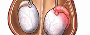 Тянет правое яичко у мужчины: причины и методы лечения