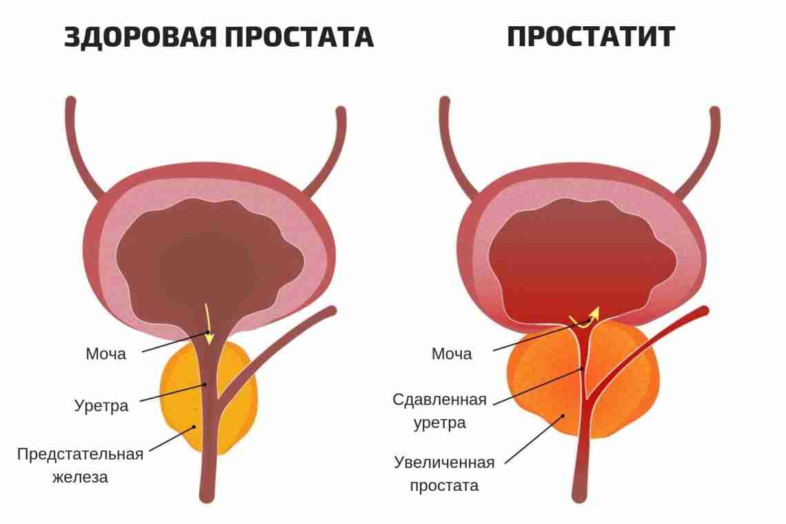 Простата увеличенная: причины и лечение