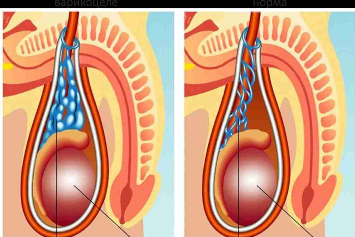 Семенной пузырек, семенной канатик: болезни и лечение