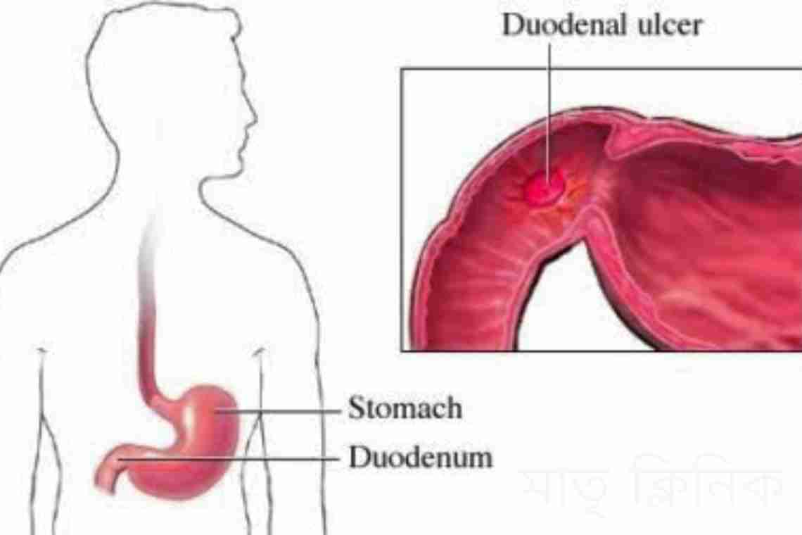 Симптомы: язва двенадцатиперстной кишки