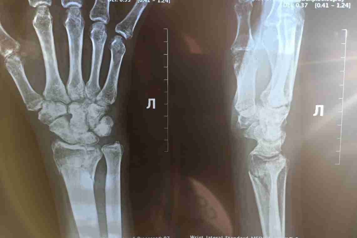 Перелом лучевой кости руки: лечение, срок срастания и реабилитация