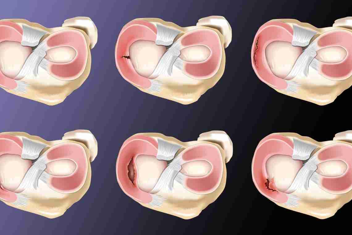 Мениск коленного сустава: симптомы и лечение повреждений