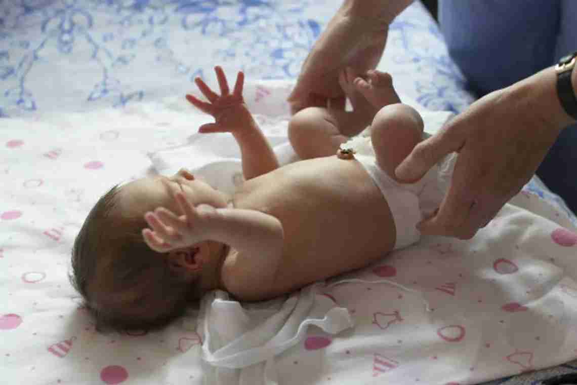 Пупочная грыжа у новорожденных: стоит ли волноваться?