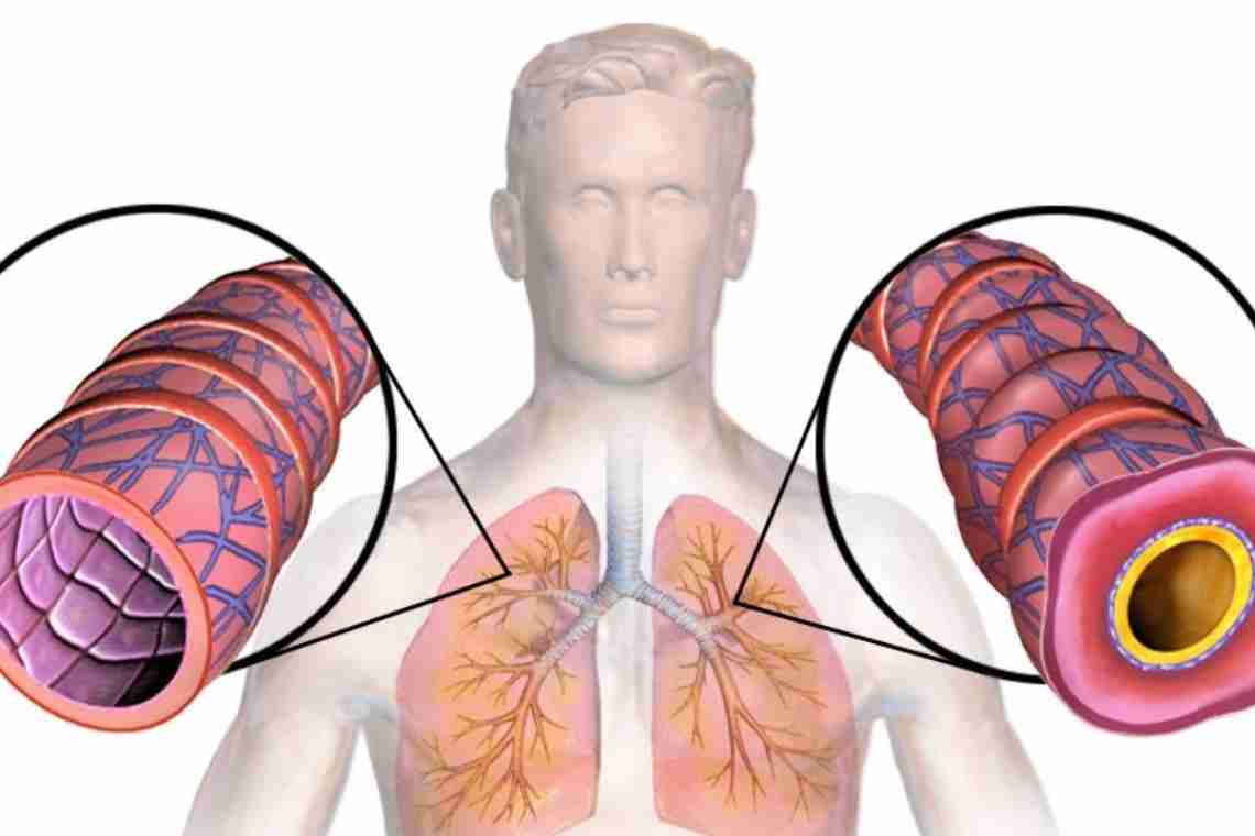 Бронхиальная астма – симптомы мучительного заболевания