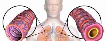 Бронхиальная астма – симптомы мучительного заболевания