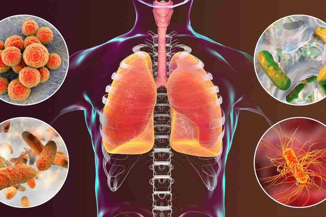 Что такое пневмония и как её лечат?