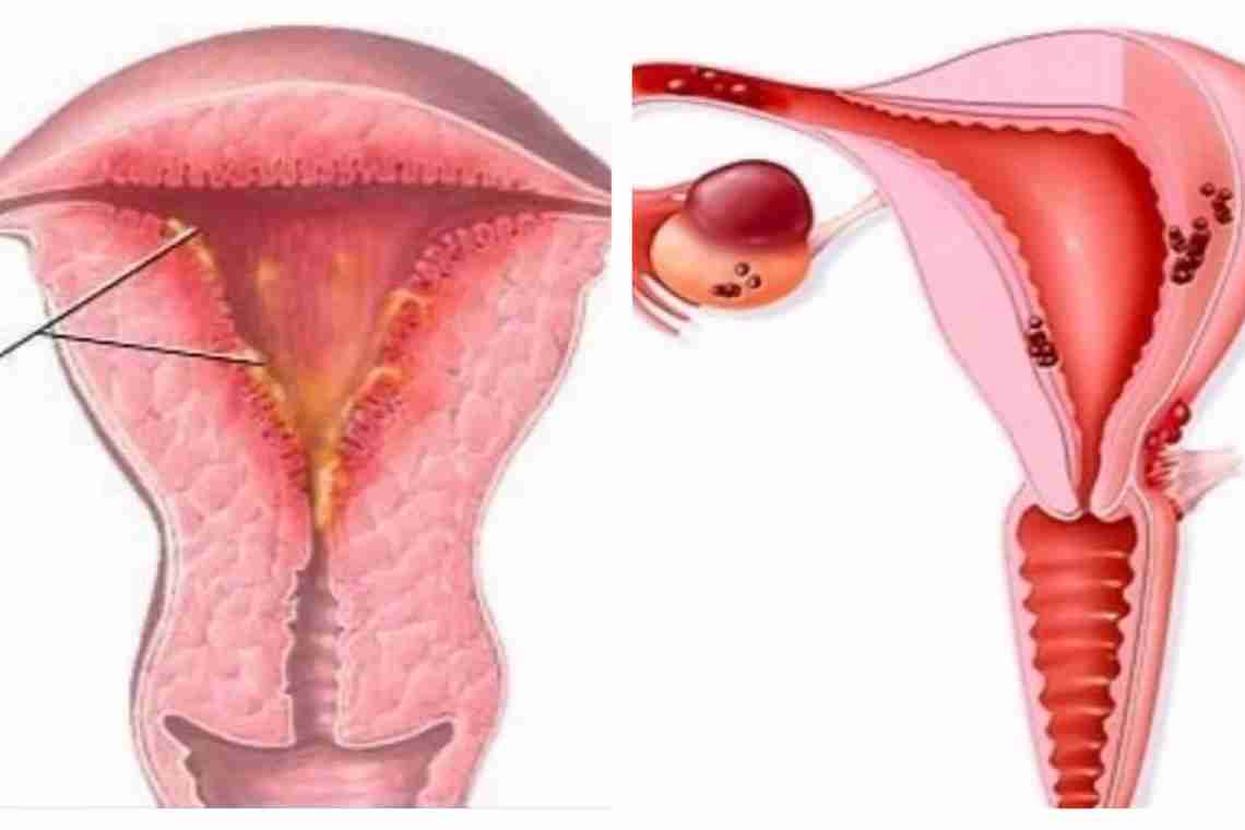 Как лечить эндометриоз матки. Другие патологии. Эндометрит.