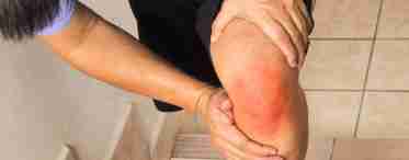 Рожистое воспаление ноги – это опасное инфекционное заболевание