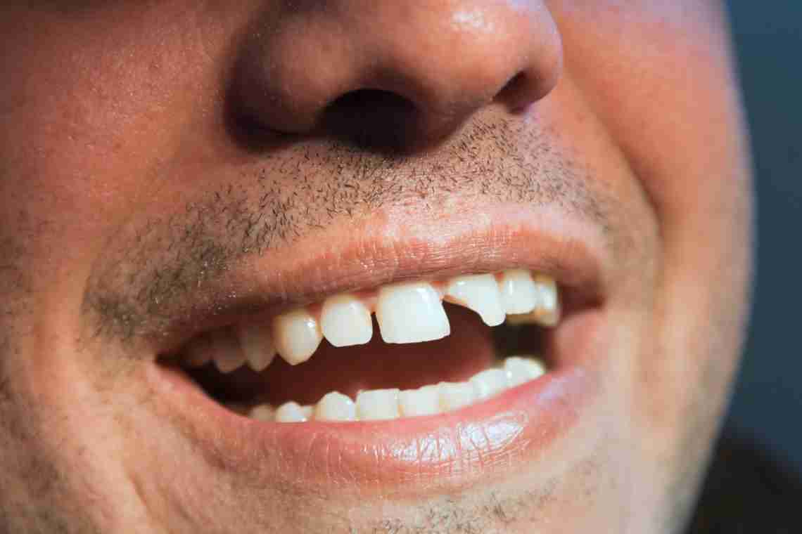 Что делать, если откололся кусочек зуба?