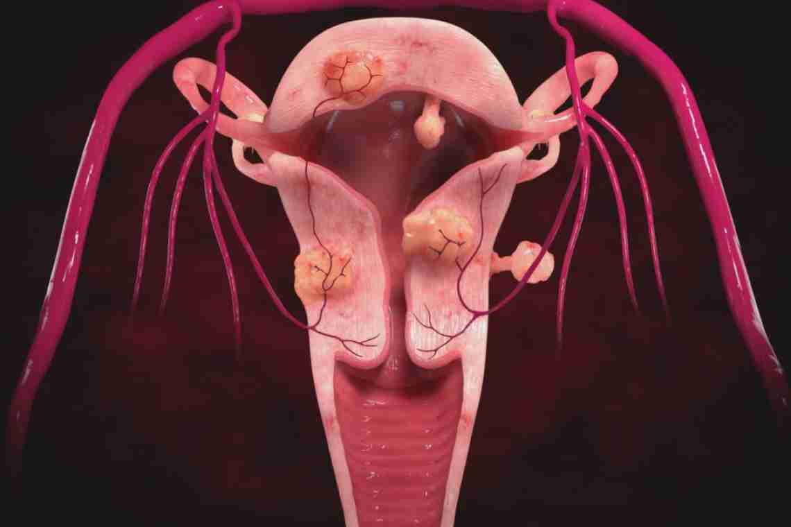 Дифференциальный диагноз миомы матки и некоторых других патологий