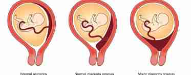 Плацента по передней стенке матки: норма или патология?