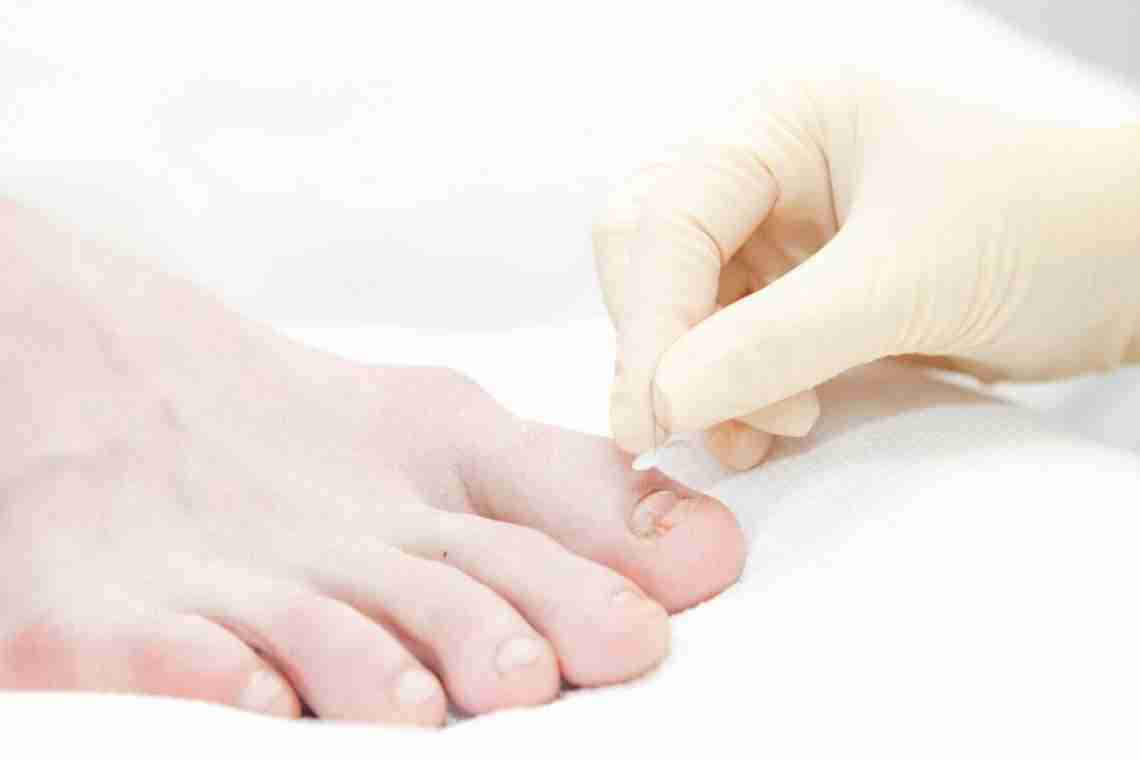 Эффективное лечение вросшего ногтя на ноге