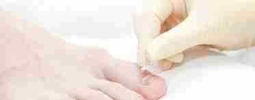 Эффективное лечение вросшего ногтя на ноге