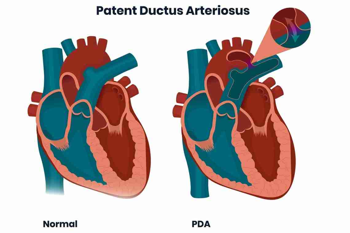 Ventricular Septal defect