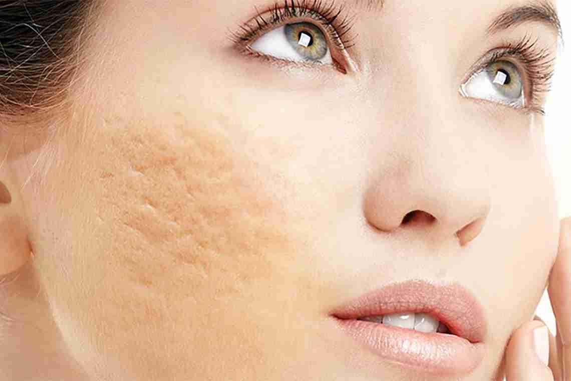 Как избавиться от рубцов, шрамов и других повреждений кожи