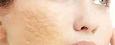 Как избавиться от рубцов, шрамов и других повреждений кожи
