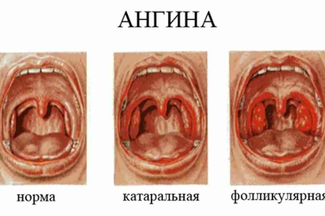 Болезни горла и гортани: симптомы, лечение