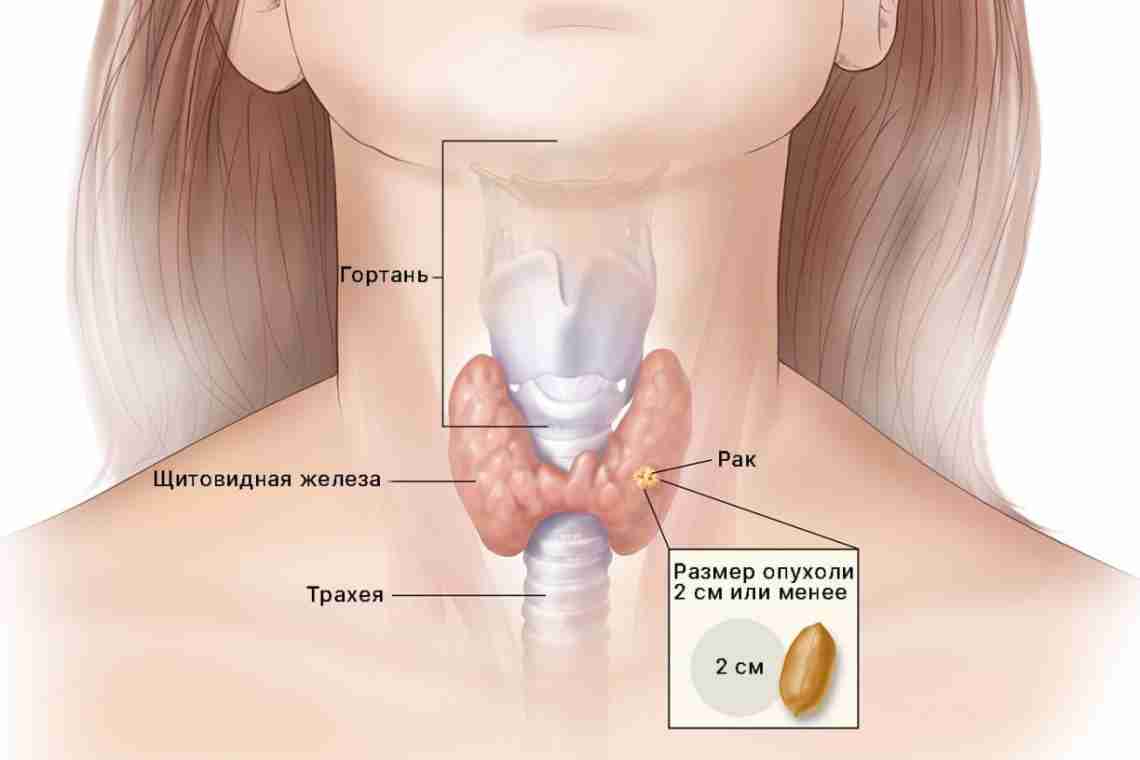 Узловой зоб щитовидной железы: причины, симптомы и методы лечения