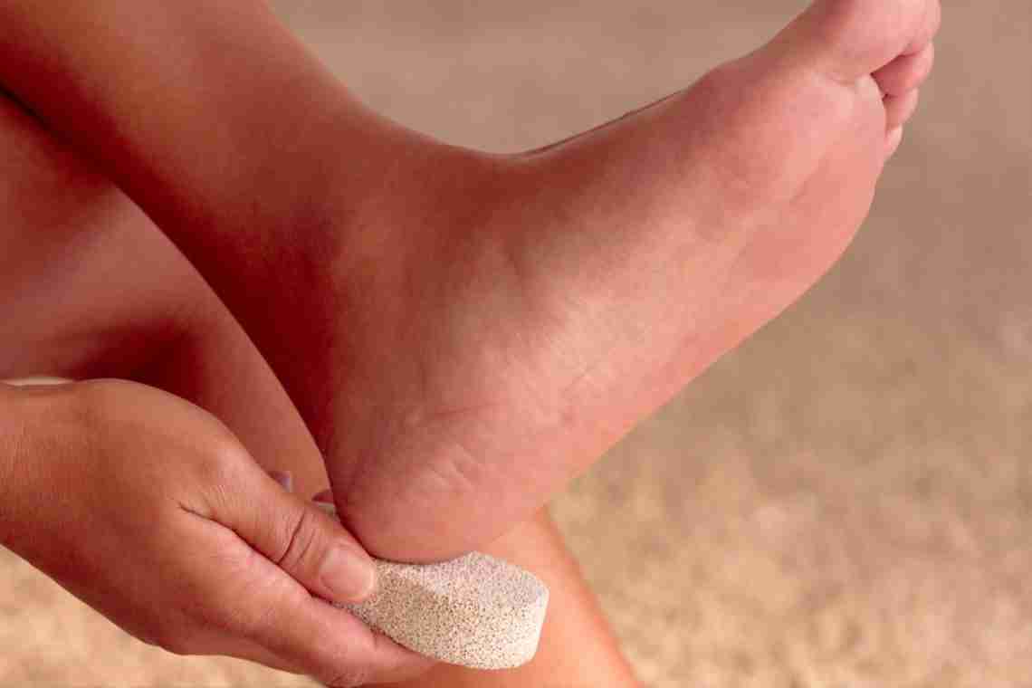 Как и чем лечат трещины на пятках и между пальцами ног? Полезные советы