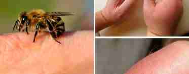 Первая помощь при укусах насекомых: пчел, комаров, клопов