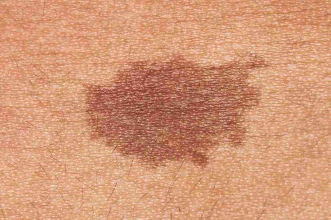 При каких заболеваниях пятно на коже шелушится?
