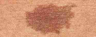 При каких заболеваниях пятно на коже шелушится?