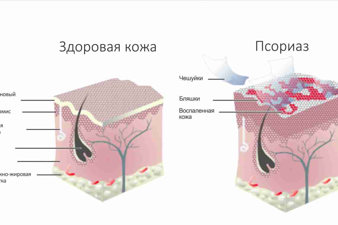 Псориаз заразен?