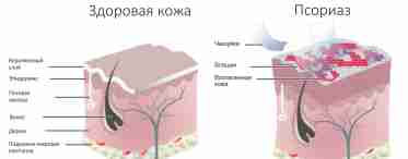 Псориаз заразен?