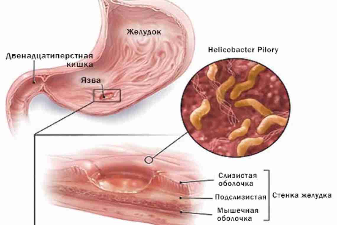 Симптомы язвы 12-перстной кишки: как вовремя распознать болезнь?