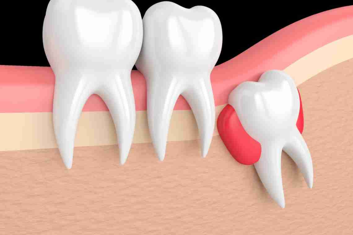 Зуб мудрости болит – что делать? Стоматолог поможет