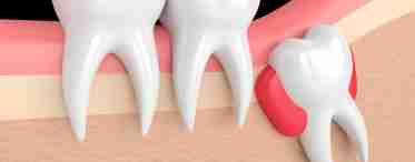 Зуб мудрости болит – что делать? Стоматолог поможет